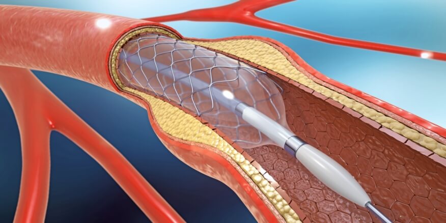 Artery Dilation in jordan 