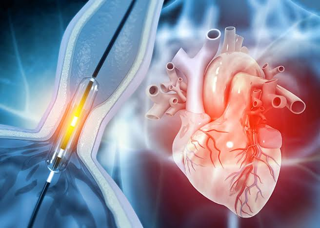 Cardiac stent placement in jordan 